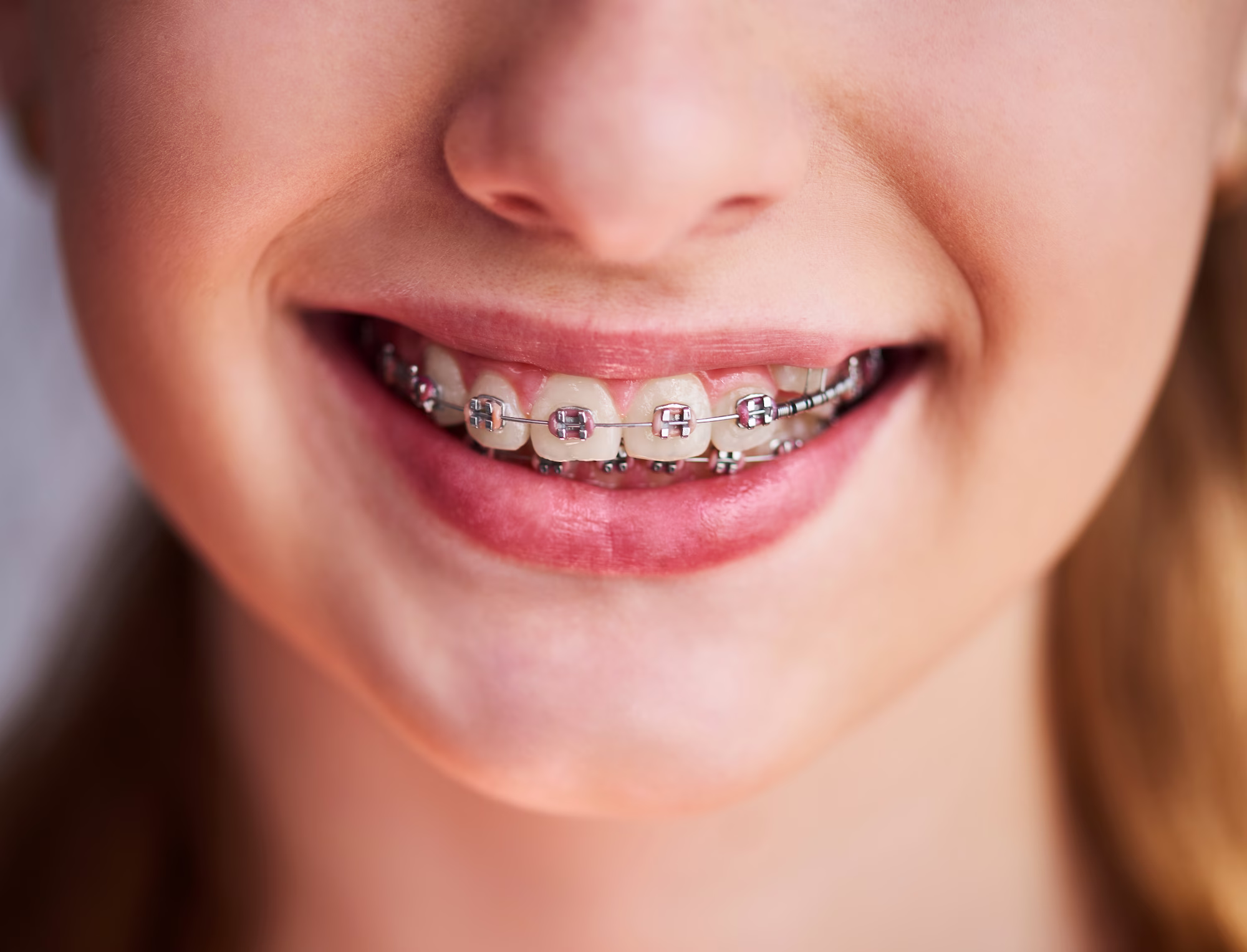 Braces 101: What to Expect When Starting Treatment